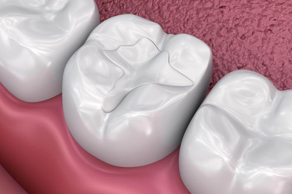 Dental Bonding & Fillings In Cape Coral, FL | Sunset Harbor Dental